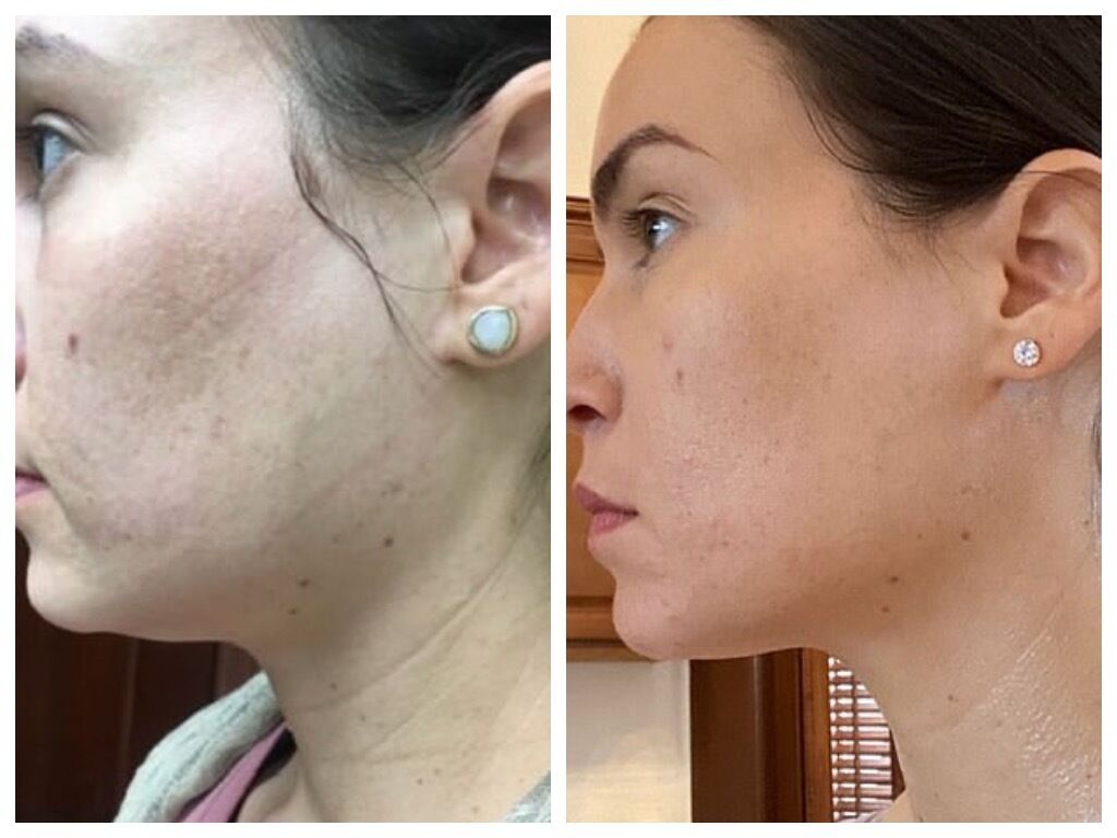 A 34-year-old woman spent $30,000 on rejuvenation and told us which procedures are really worth the money and which should be avoided