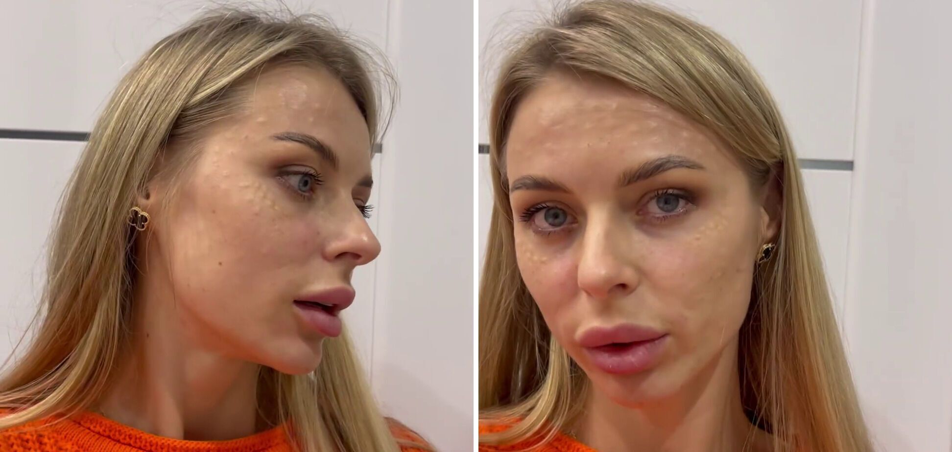 Wife of Ukrainian national football team player got unsuccessful lip augmentation: she showed the consequences