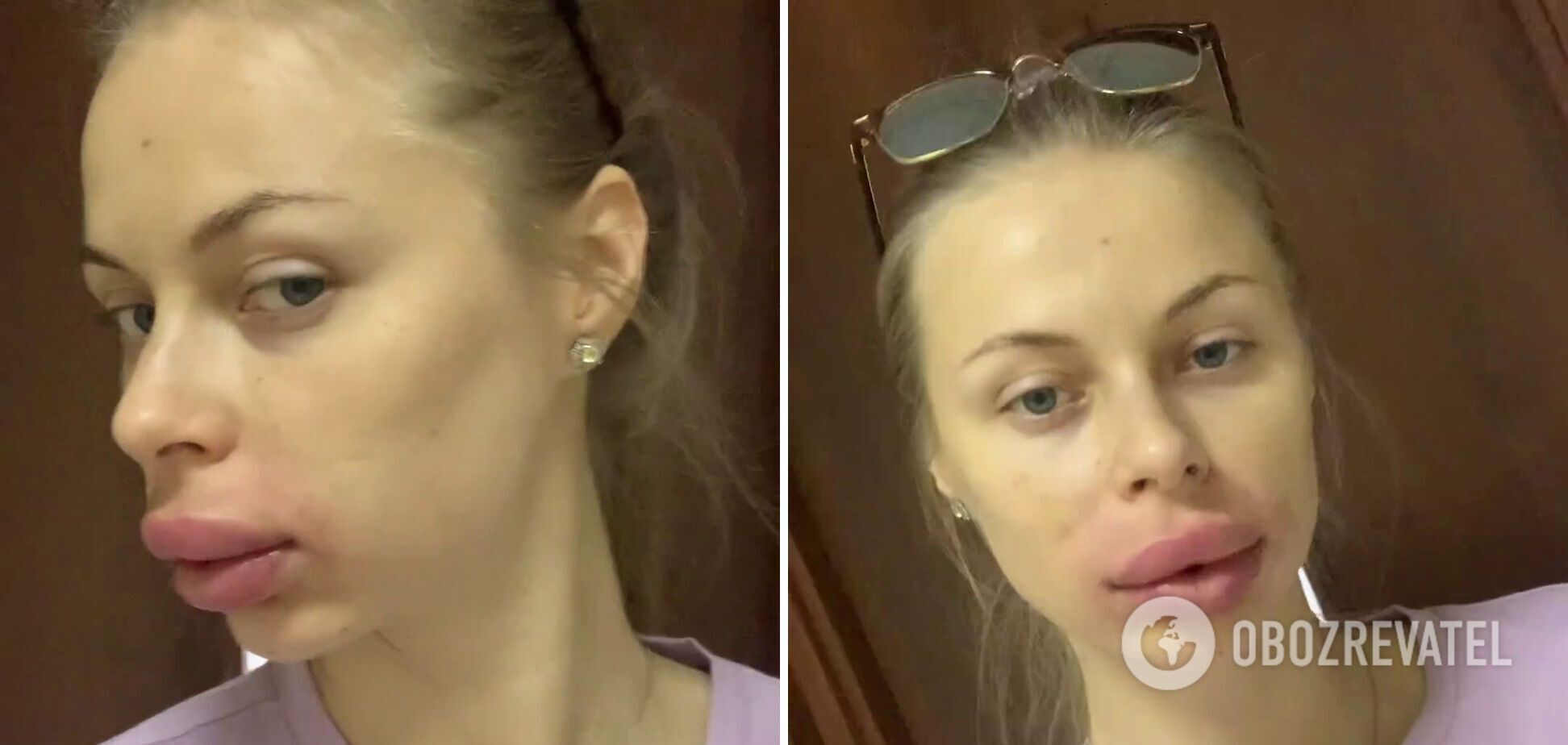 Wife of Ukrainian national football team player got unsuccessful lip augmentation: she showed the consequences