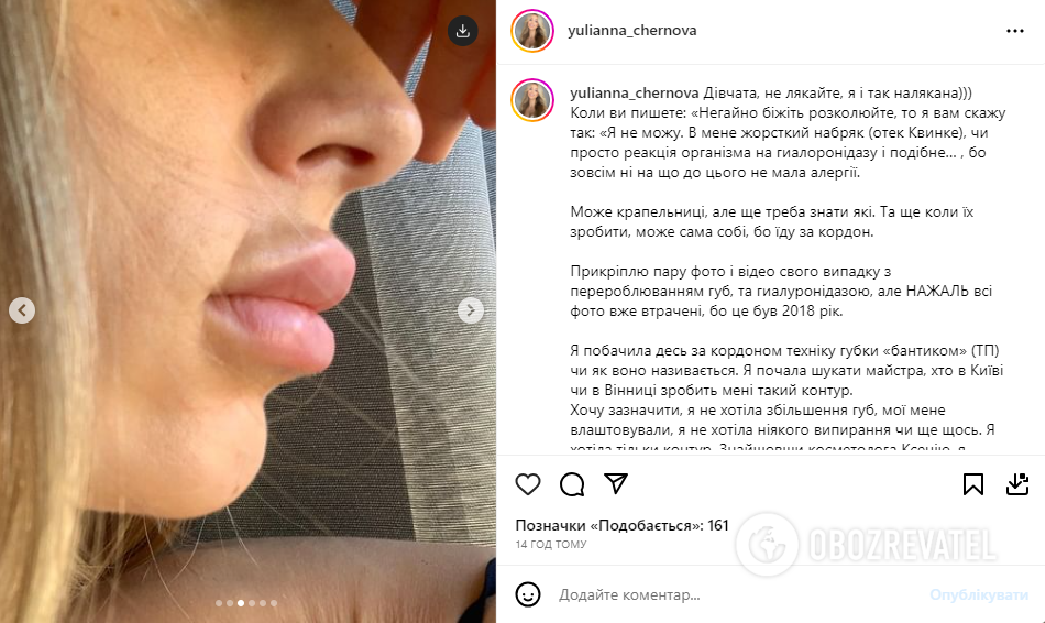 Wife of Ukrainian national football team player got unsuccessful lip augmentation: she showed the consequences