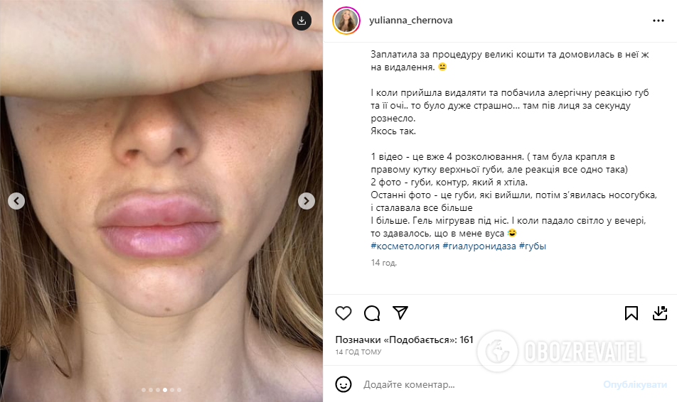 Wife of Ukrainian national football team player got unsuccessful lip augmentation: she showed the consequences