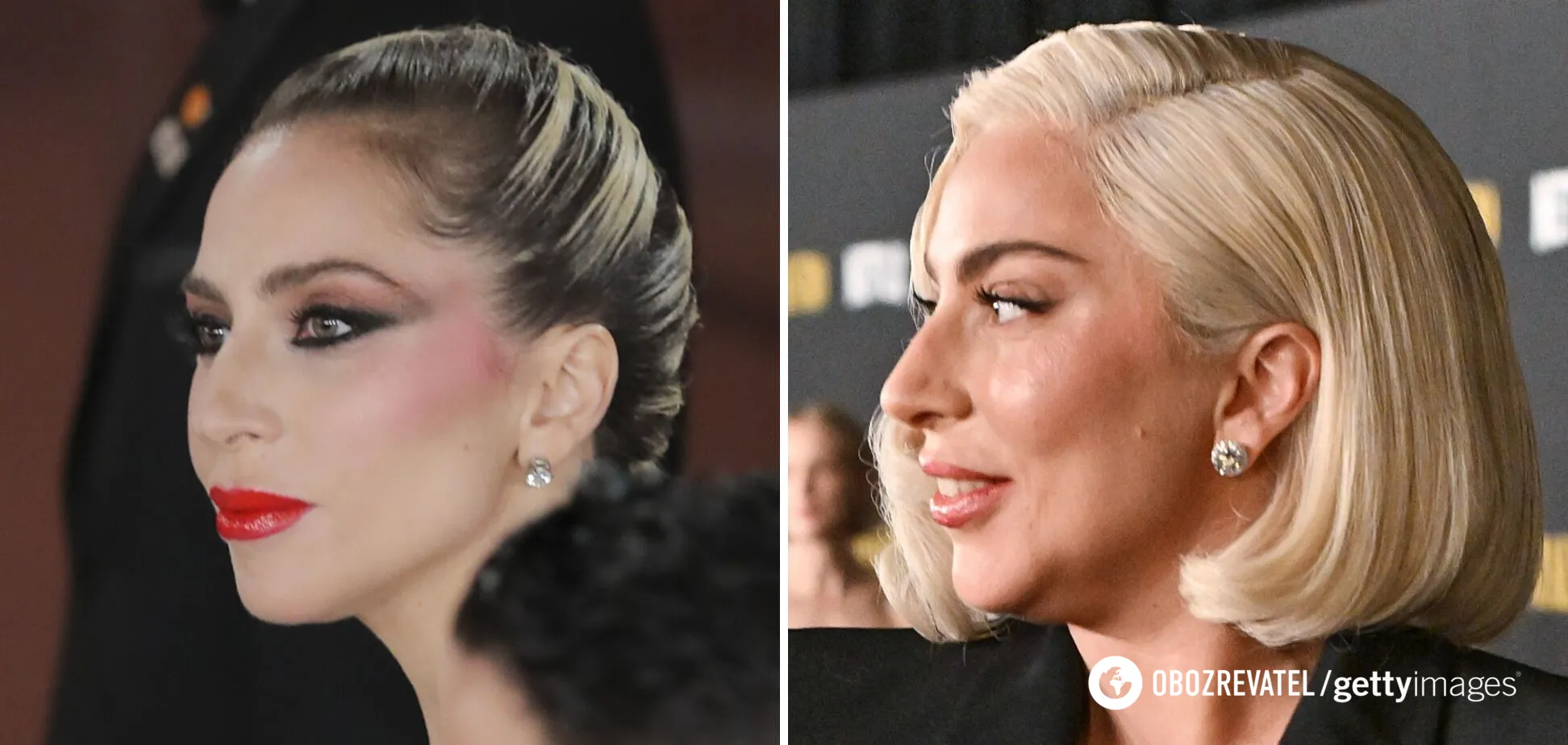 Lady Gaga, 37, disappointed fans with Botox and fillers in her face. Photos before and after