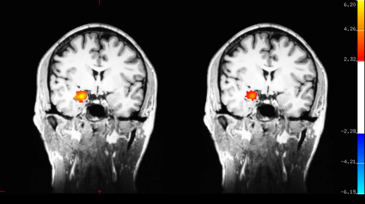 How the brain responds to meditation