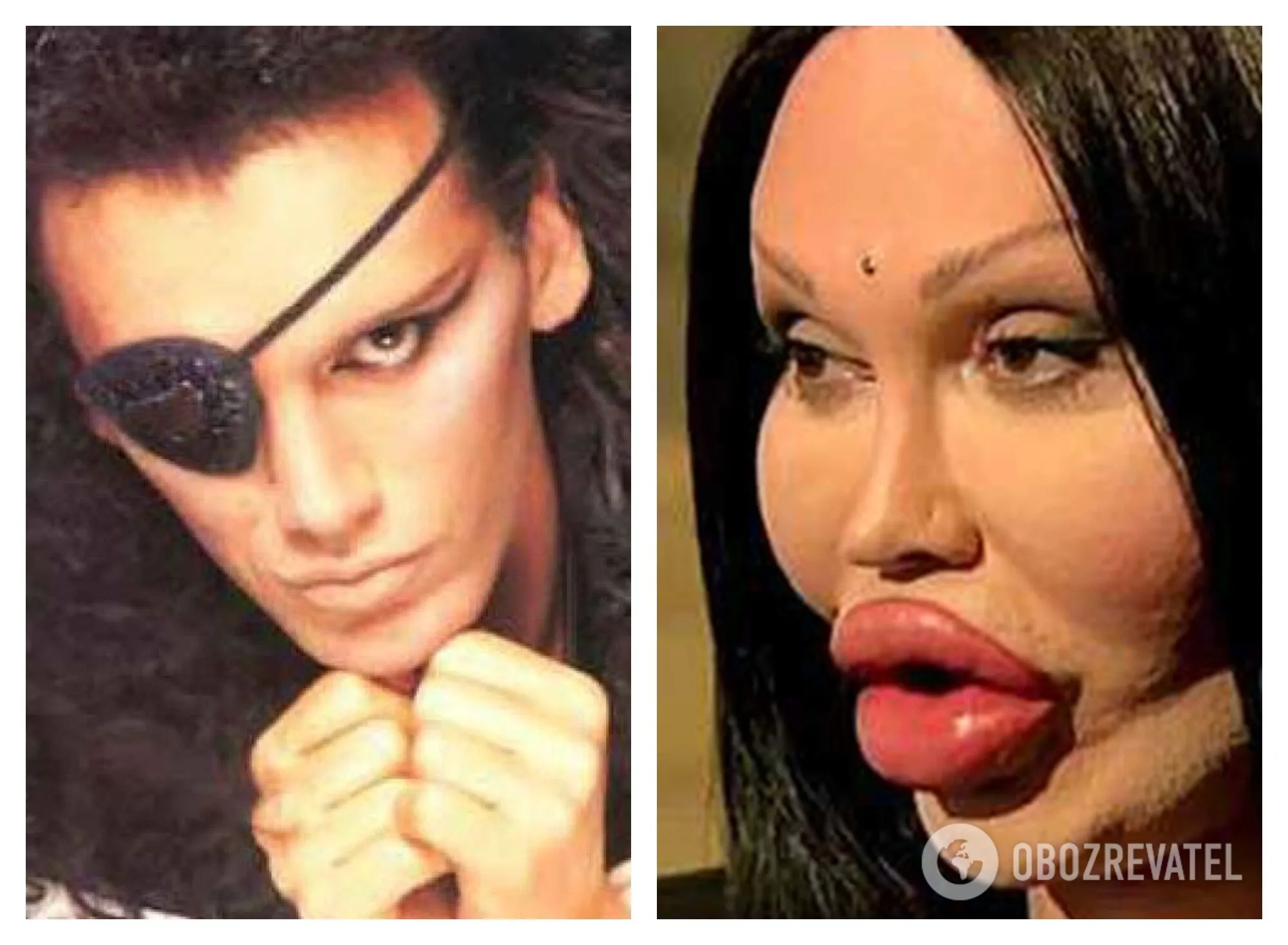 Pete Burns: before and after plastic surgery
