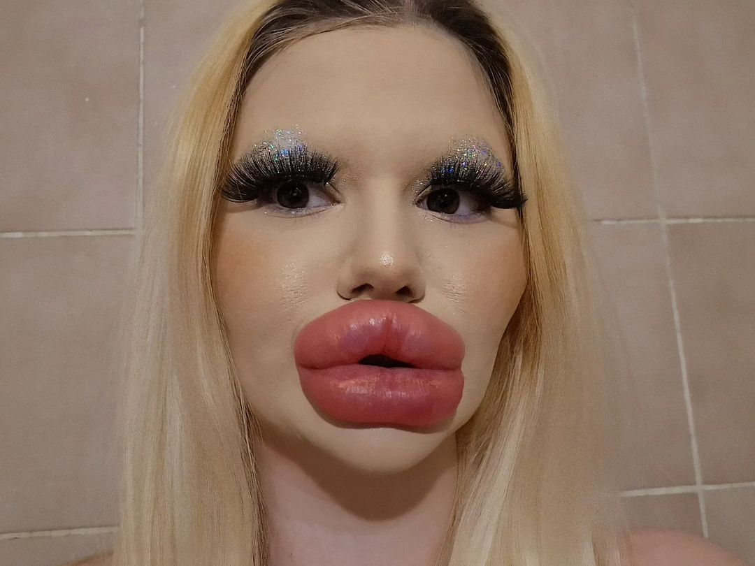 The woman with the world's biggest lips had 6 injections in one day despite the doctor's warning that her body would start to rot. Photo