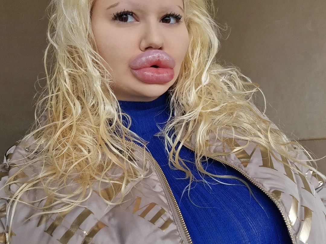 The woman with the world's biggest lips had 6 injections in one day despite the doctor's warning that her body would start to rot. Photo