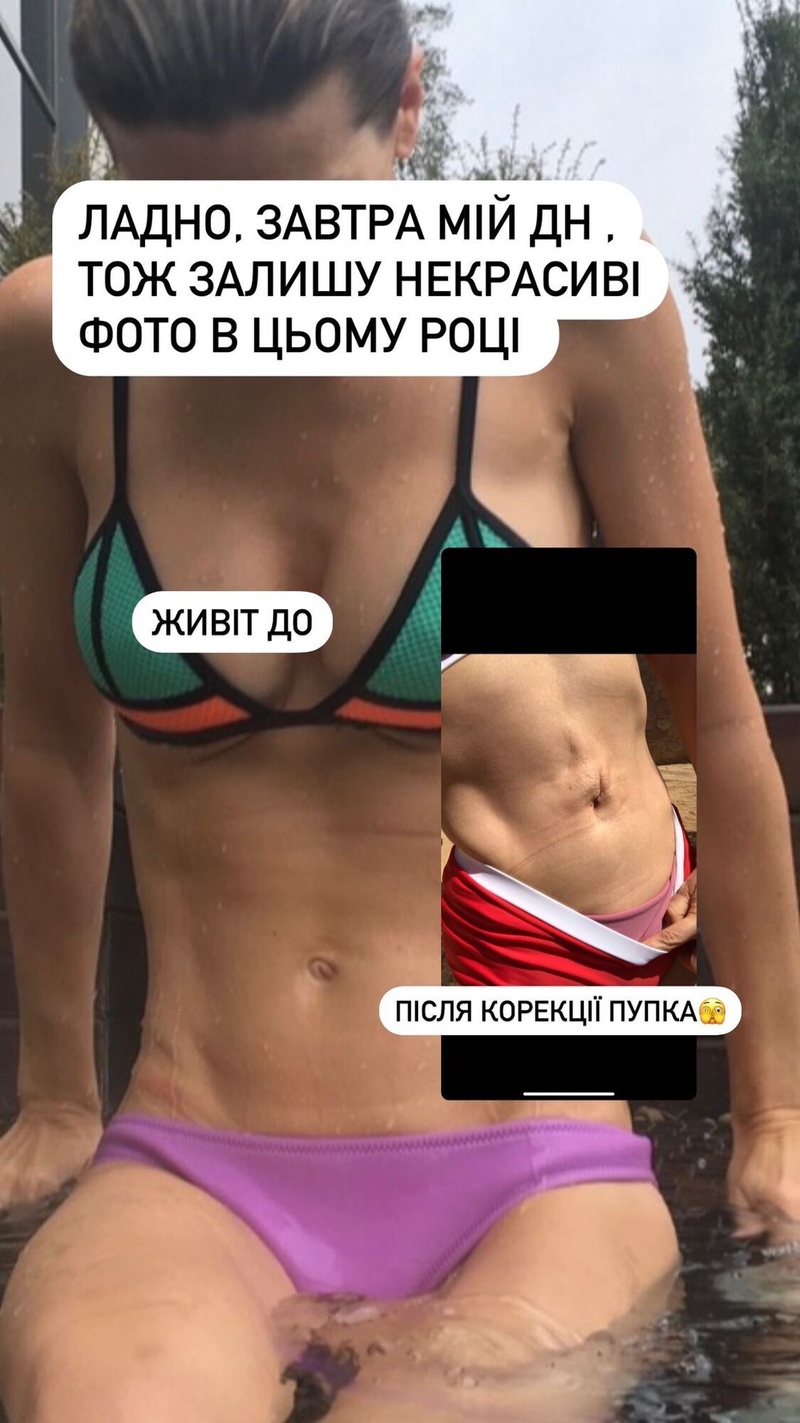 For the first time, Anita Lutsenko showed a photo of how she was disfigured by a surgeon from the top 10 best in Ukraine and explained why she has been hiding her stomach lately
