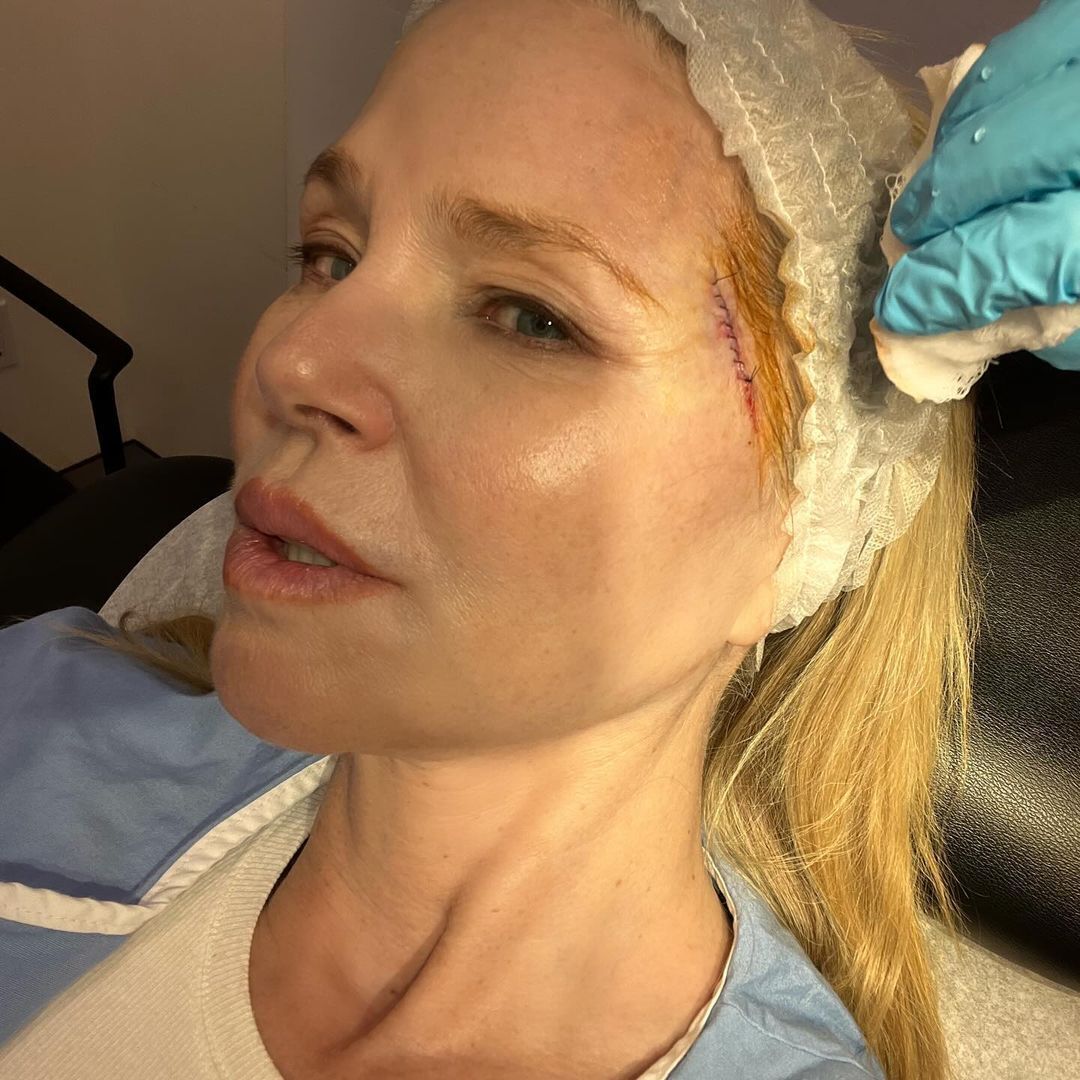 Christie Brinkley has been diagnosed with skin cancer: 70-year-old supermodel shows first photos after surgery