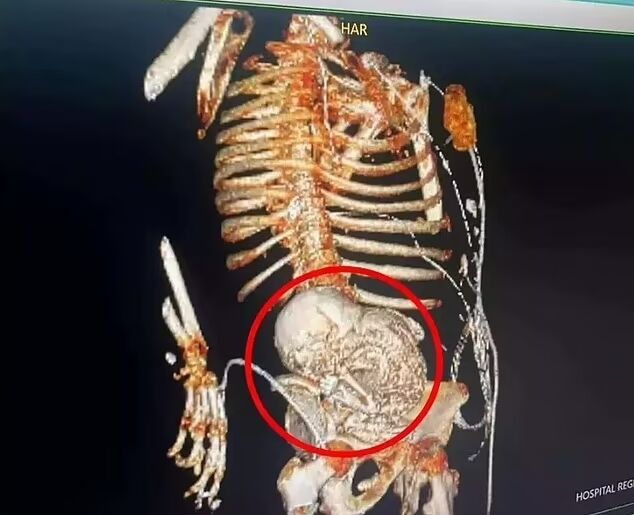 81-letnia Brazylijka została znaleziona ze skamieniałym zarodkiem w żołądku: nosiła płód przez 56 lat i nie wiedziała o tym. Zdjęcie