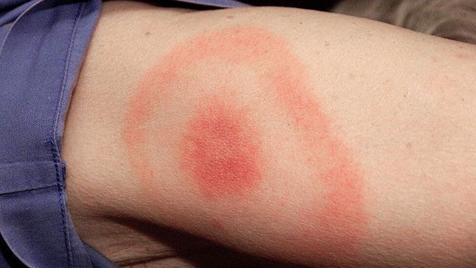 Rumień pełzający w chorobie z Lyme to charakterystyczna czerwona plama w miejscu ukąszenia przez zakażonego kleszcza.