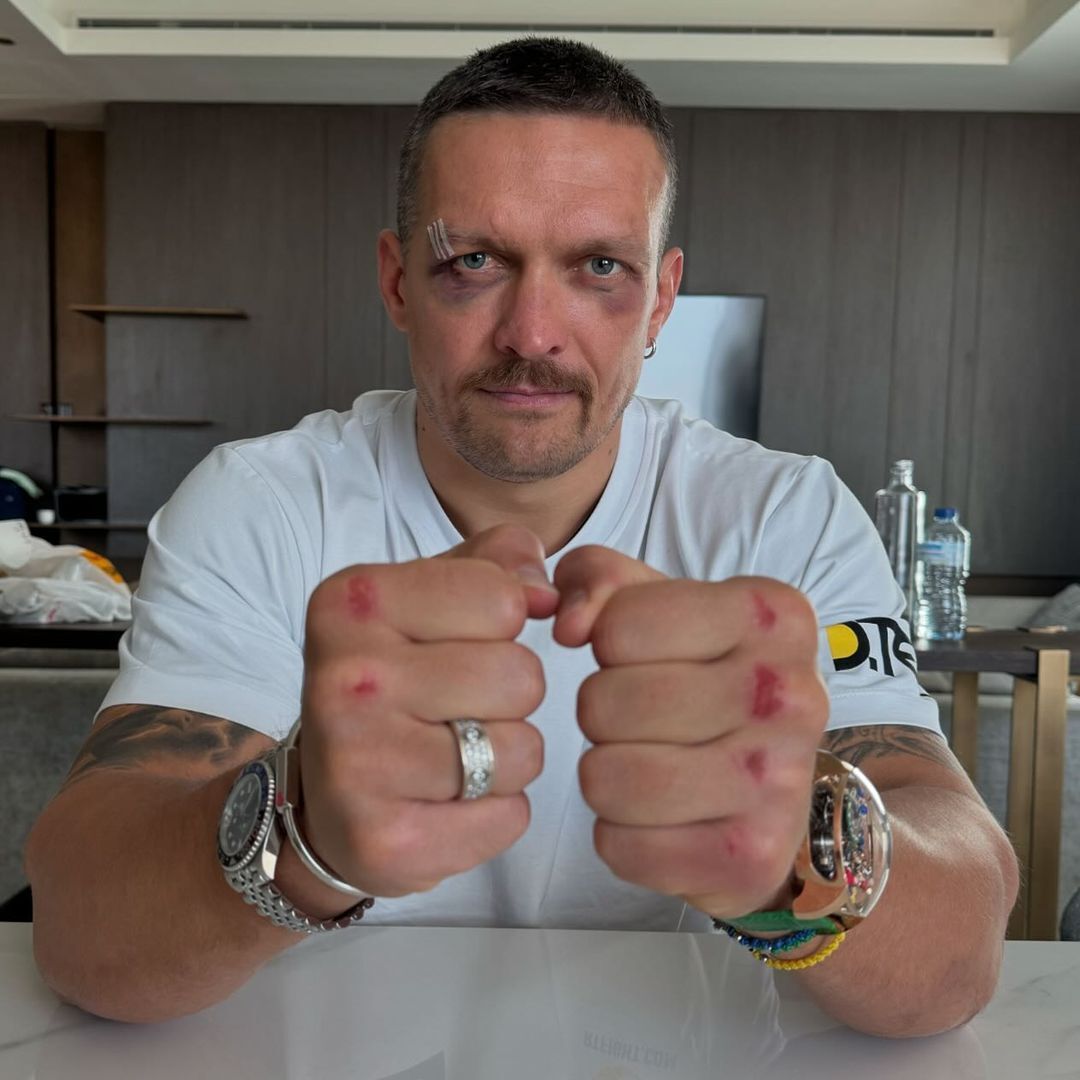 Usyk showed how he looks three days after the fight with Fury. Photo