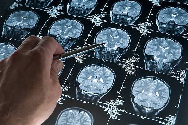 Unique cases of Alzheimer's may hold the key to beating the disease – study