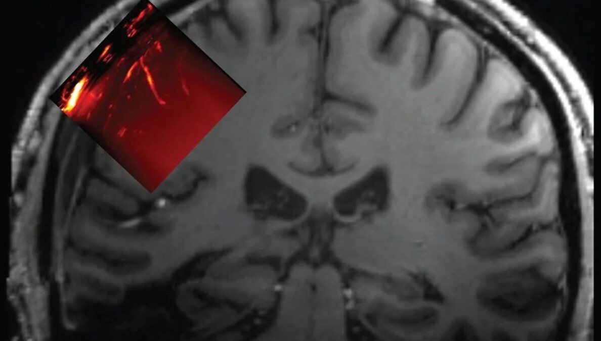 Scientists have inserted a ''window'' into a man's skull to look into his brain