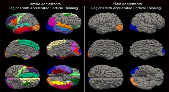 The COVID-19 pandemic has aged the brains of adolescents: girls have suffered the most. Results of the study