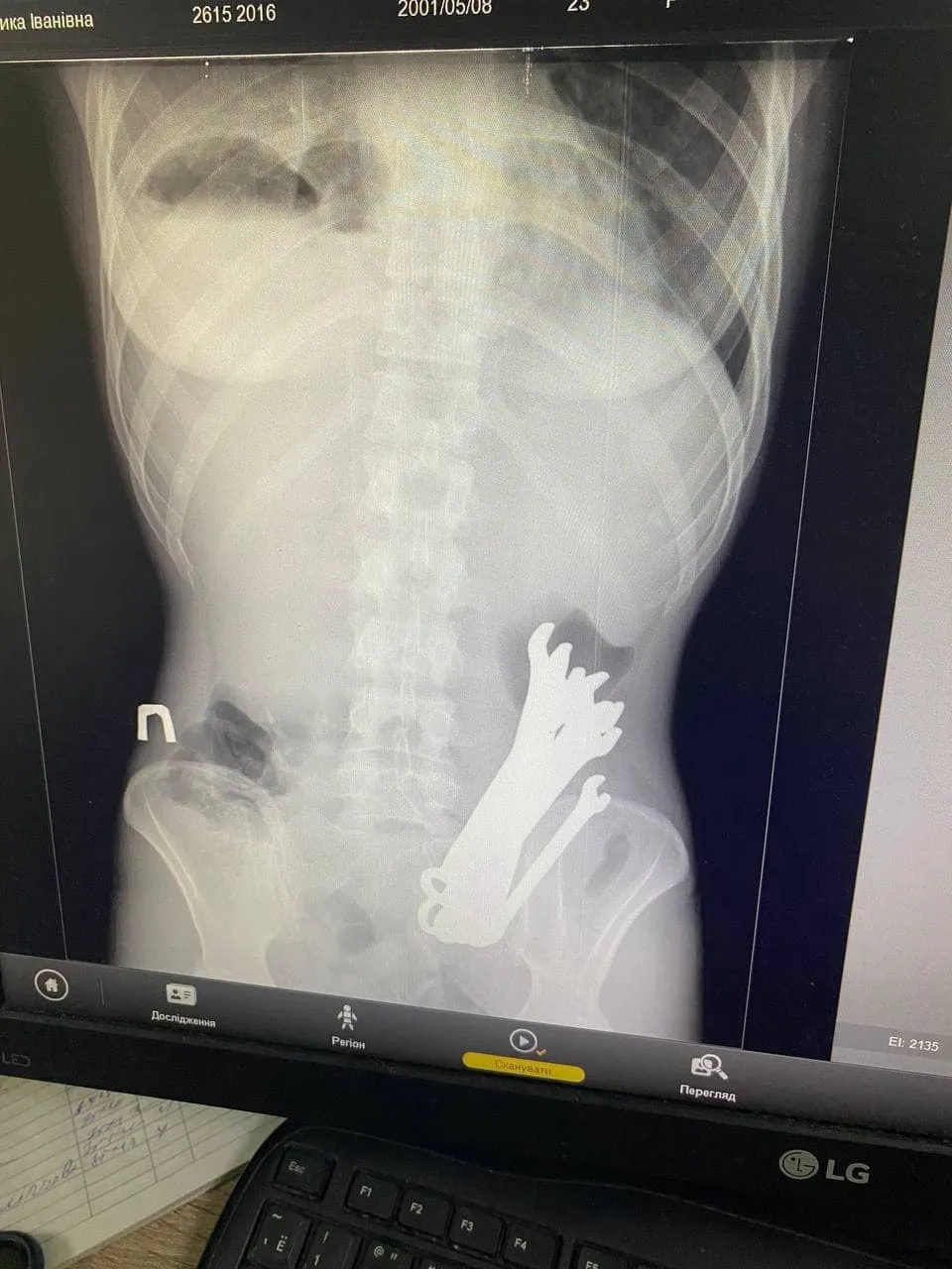 In Cherkasy, doctors rescued a patient whose stomach contained six wrenches. Photo