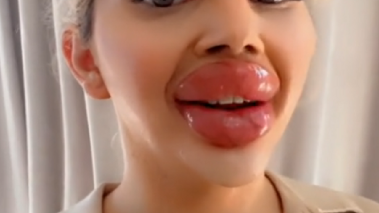 Tiktocker injected 30ml of filler into her lips and wants to inject some more