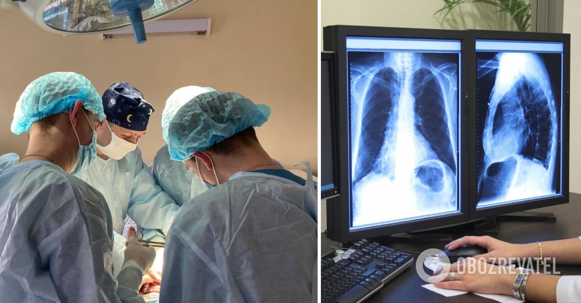 A unique lung transplant from a posthumous donor was performed in Lviv for 16 hours