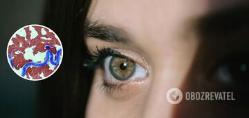 In Lviv region, a 24-year-old girl had a 14-centimeter worm removed from under her eye