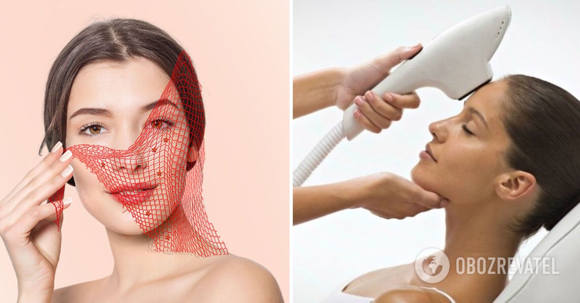 Can dilated blood vessels be removed permanently and what to do to prevent them from reappearing