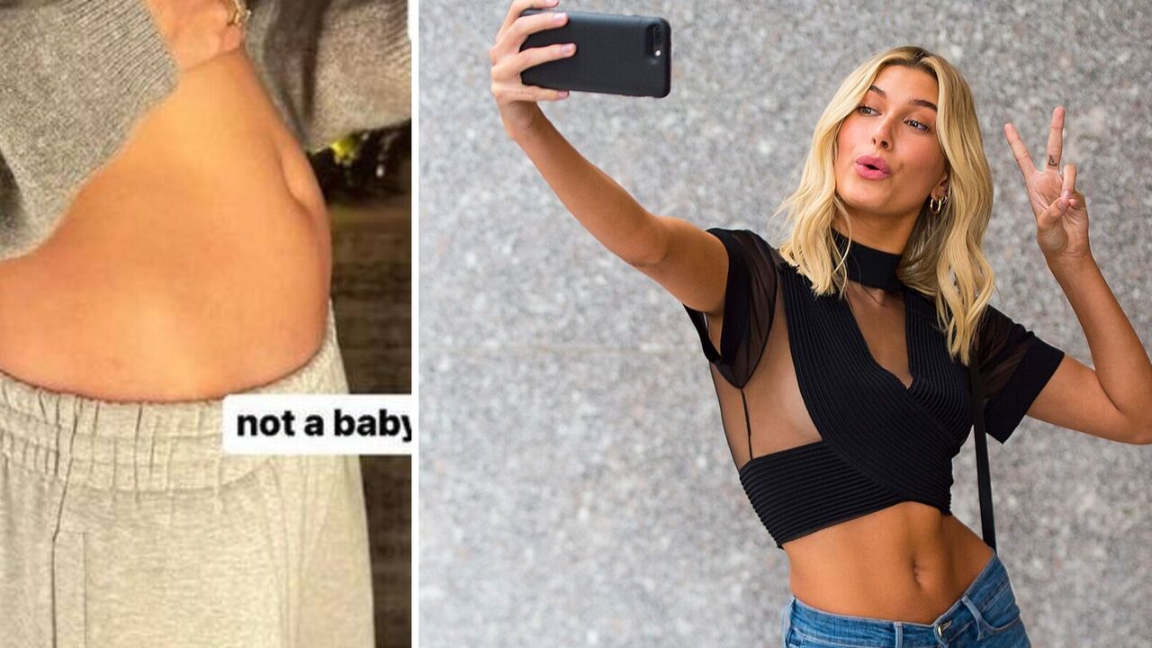 "The size of an apple": Hailey Bieber spoke about the dangerous cyst that makes her look pregnant. Photo