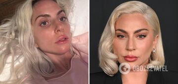 Lady Gaga, 37, disappointed fans with Botox and fillers in her face. Photos before and after