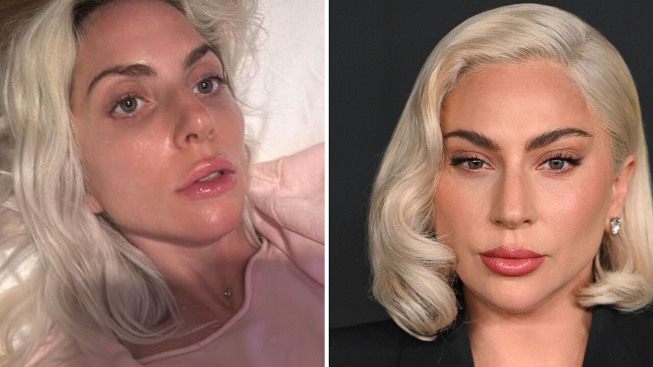 Lady Gaga, 37, disappointed fans with Botox and fillers in her face. Photos before and after