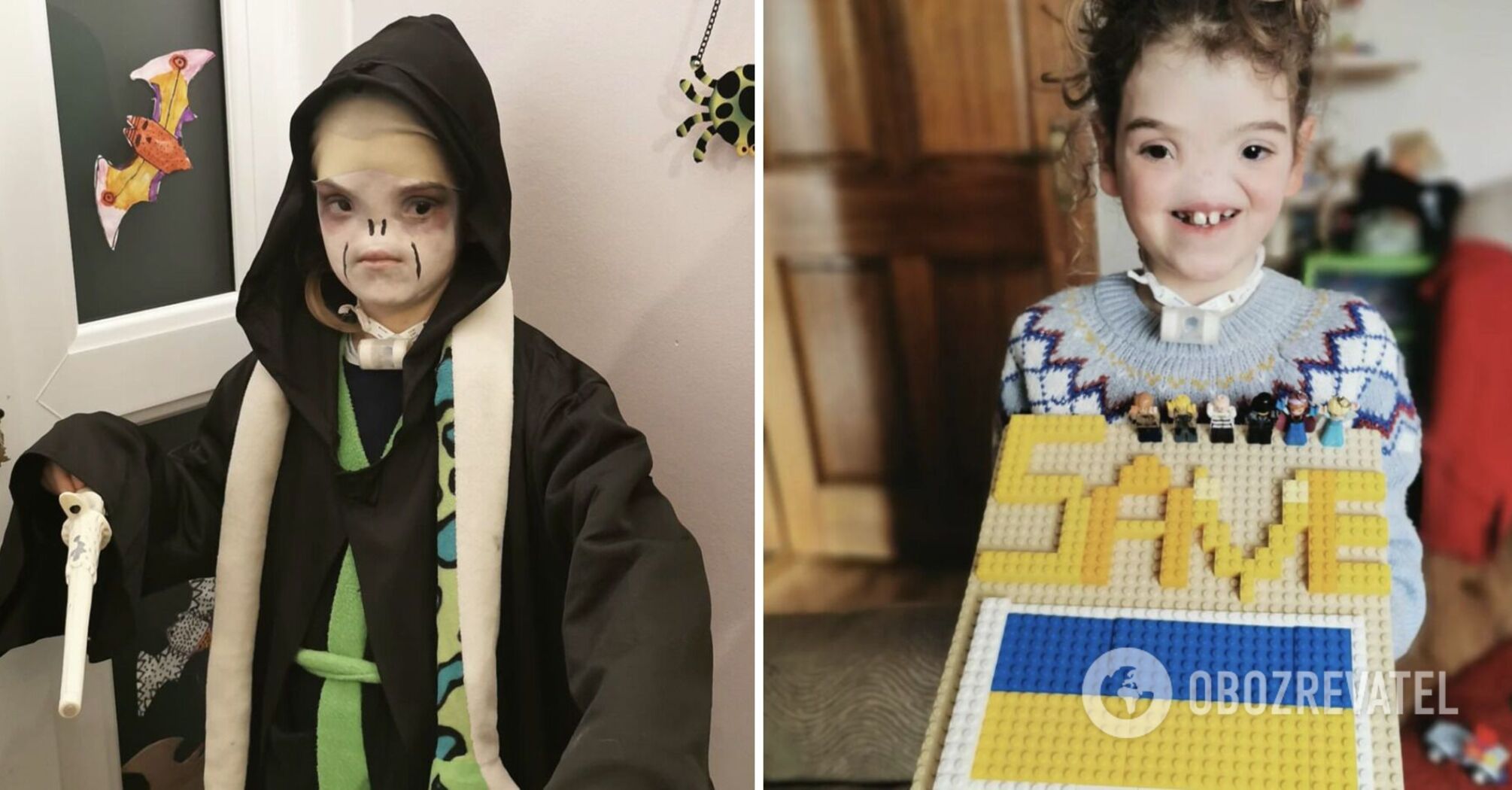 They called her "Voldemort": what a 10-year-old girl from the UK born without a nose looks like today