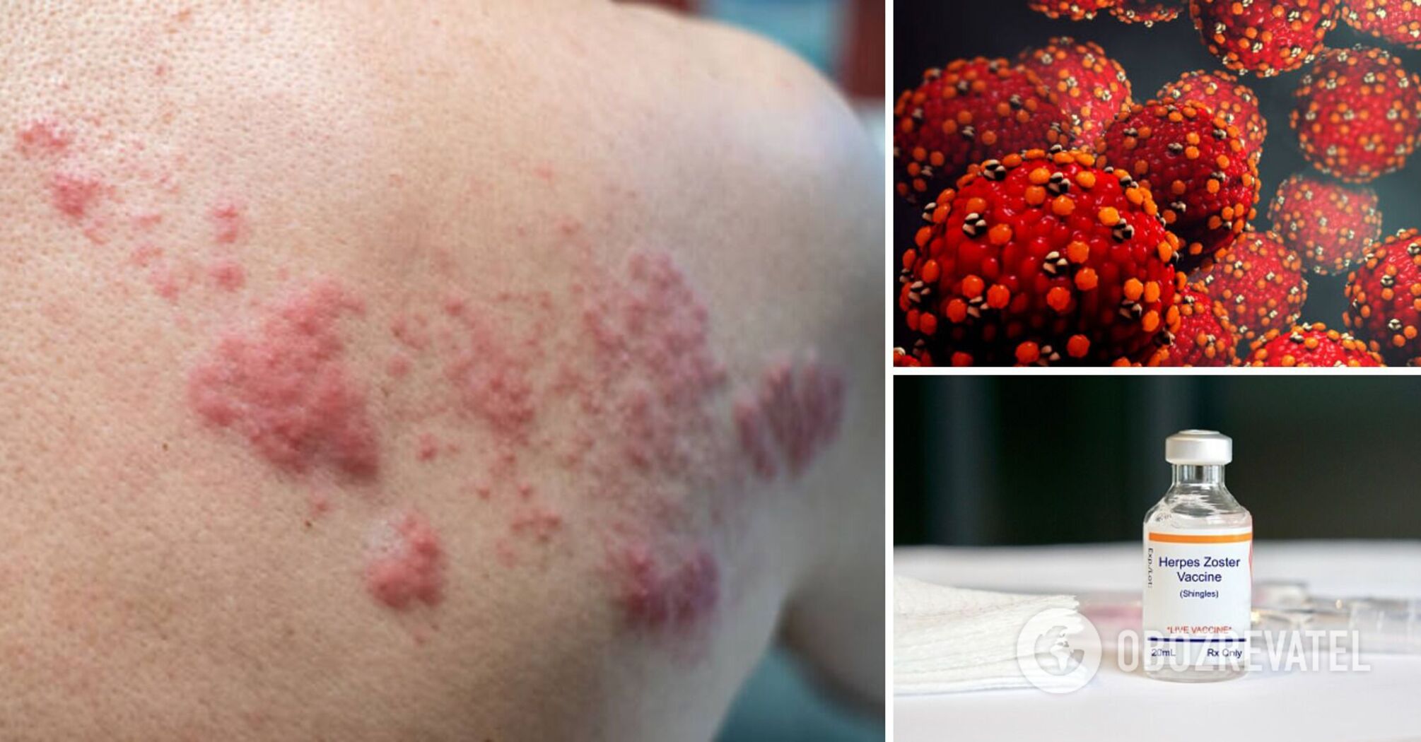 Doctors tell about possible manifestations of shingles