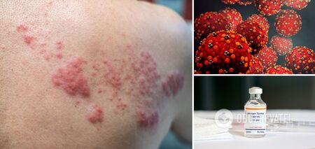 Doctors tell about possible manifestations of shingles