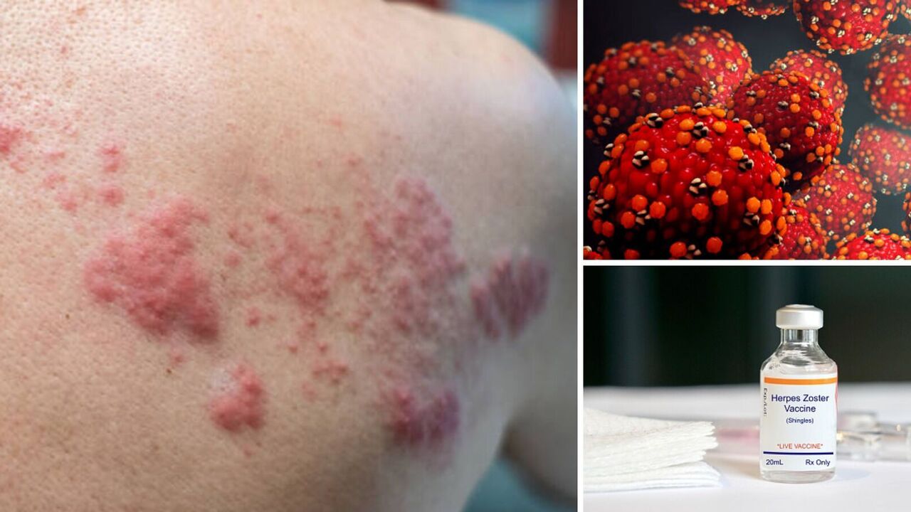 Doctors tell about possible manifestations of shingles