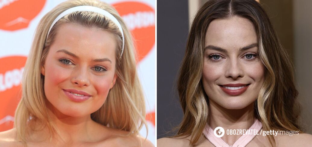 Got rid of chubby cheeks: 5 celebrities who removed Bisha lumps (before and after photos)