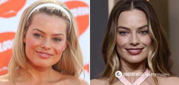 Got rid of chubby cheeks: 5 celebrities who removed Bisha lumps (before and after photos)