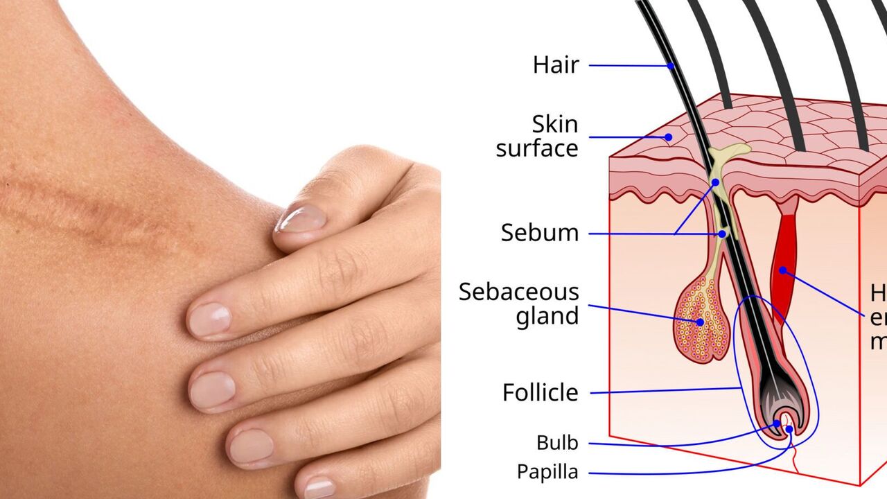 Scientists have found a way to get rid of scars without plastic surgery