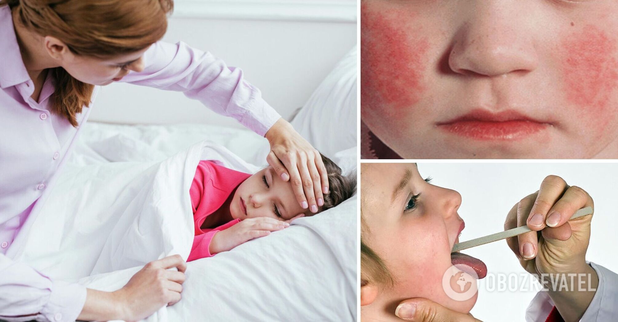There was an outbreak of scarlet fever among children in the Pre-Carpathian region