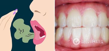Bad breath: doctors name causes and ways to deal with it