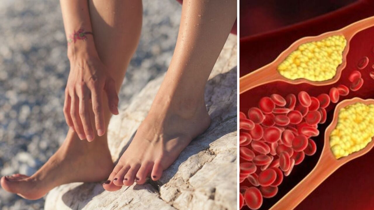 The symptom on the legs was called a sign of high cholesterol