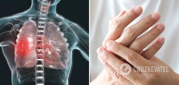 A person's hands can 'read' the symptoms of lung diseases: how to recognize a dangerous diagnosis