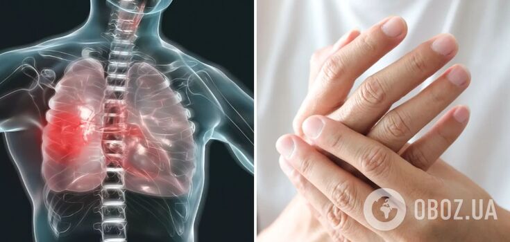 Ręce człowieka mogą "czytać" objawy choroby płuc: jak dostrzec niebezpieczną diagnozę