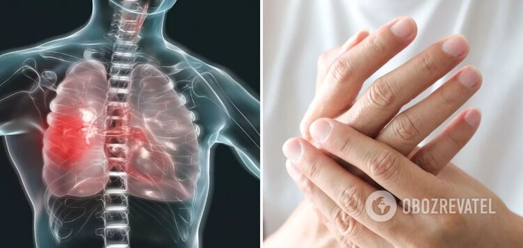 A person's hands can 'read' the symptoms of lung diseases: how to recognize a dangerous diagnosis