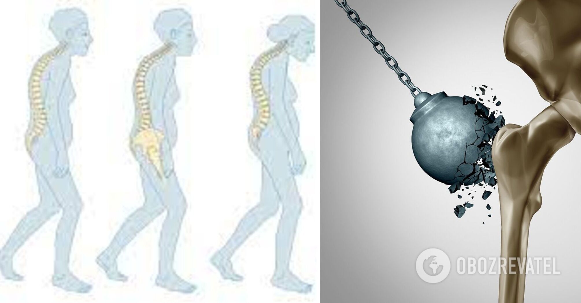 How to keep bones strong: the experts named the main ways