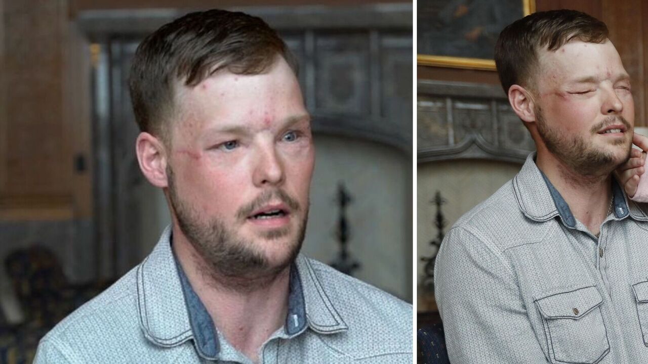 Doctors in the US have performed a face transplant