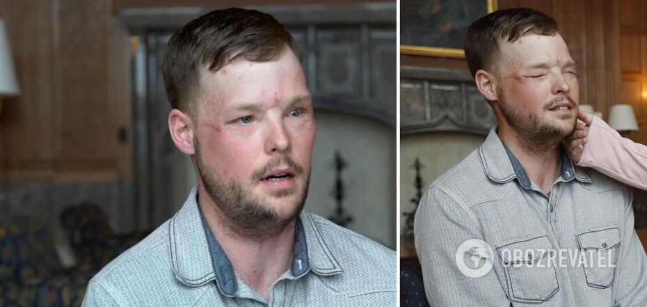 Doctors in the US have performed a face transplant