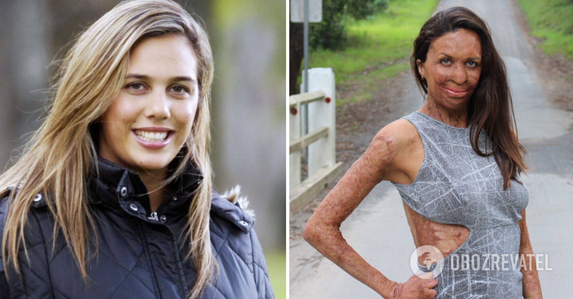 Passed through the pain, but did not break: how the fate of the famous beauties who were poured acid. Photo