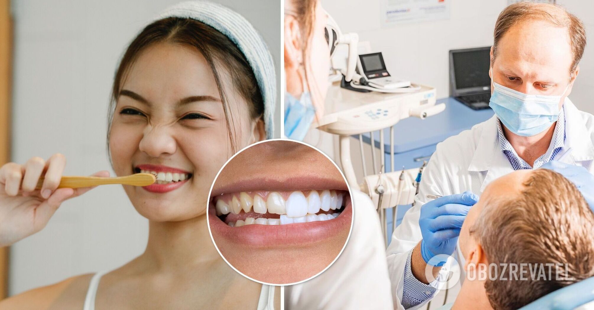 Veneers or your teeth: the dentist named the pros and cons of a Hollywood smile