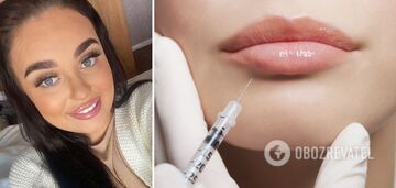The 21-year-old Englishwoman almost lost part of her face after lip augmentation. Photo