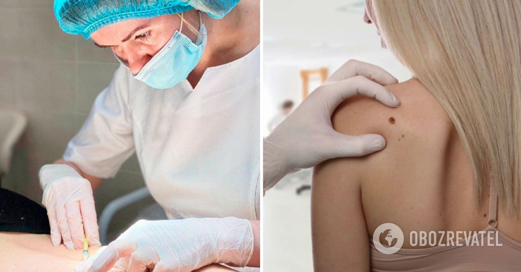 Removing moles surgically: when you need this and how the procedure is performed