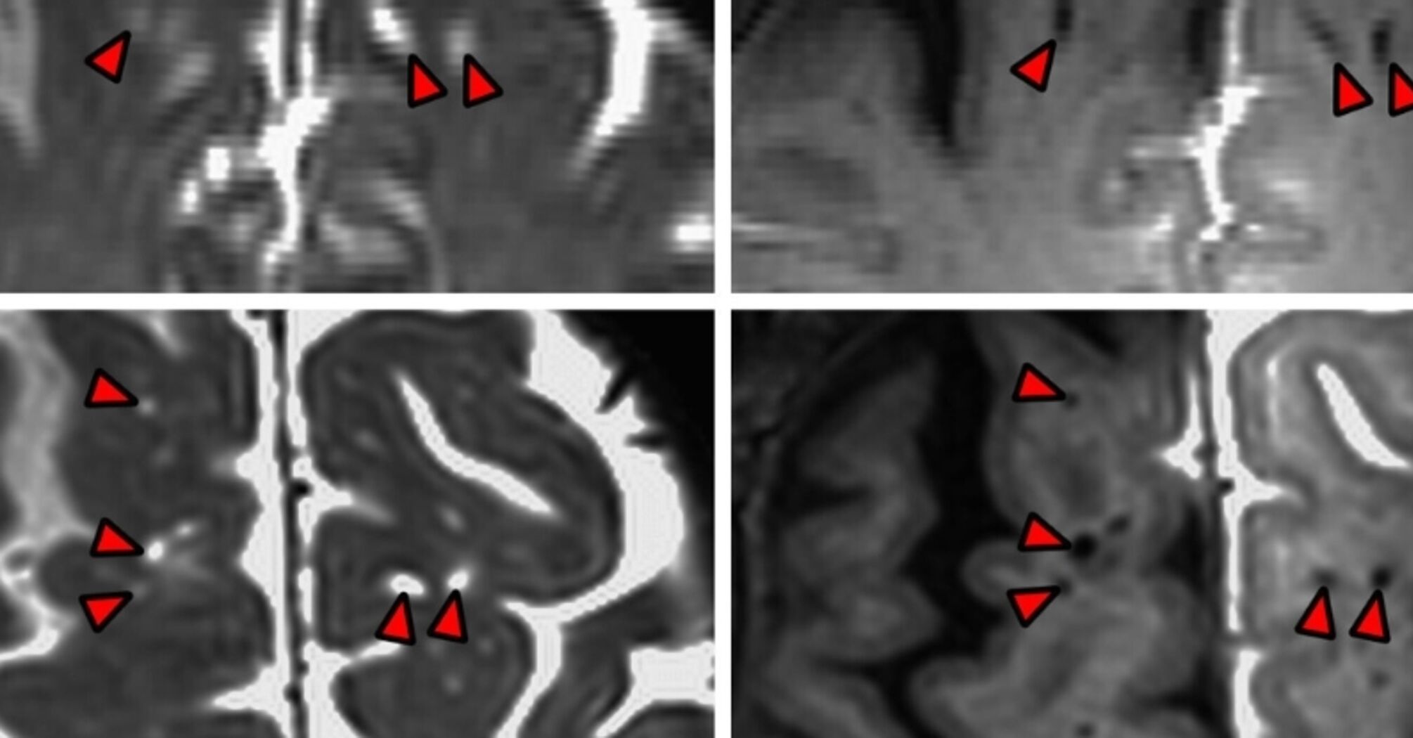 Scientists map the 'sewage system' of the human brain for the first time