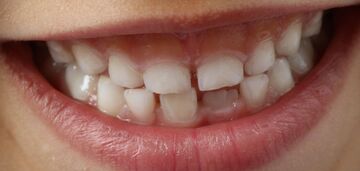 Паразиты, генетика или...: о чем может свидетельствовать скрежет зубов у ребенка