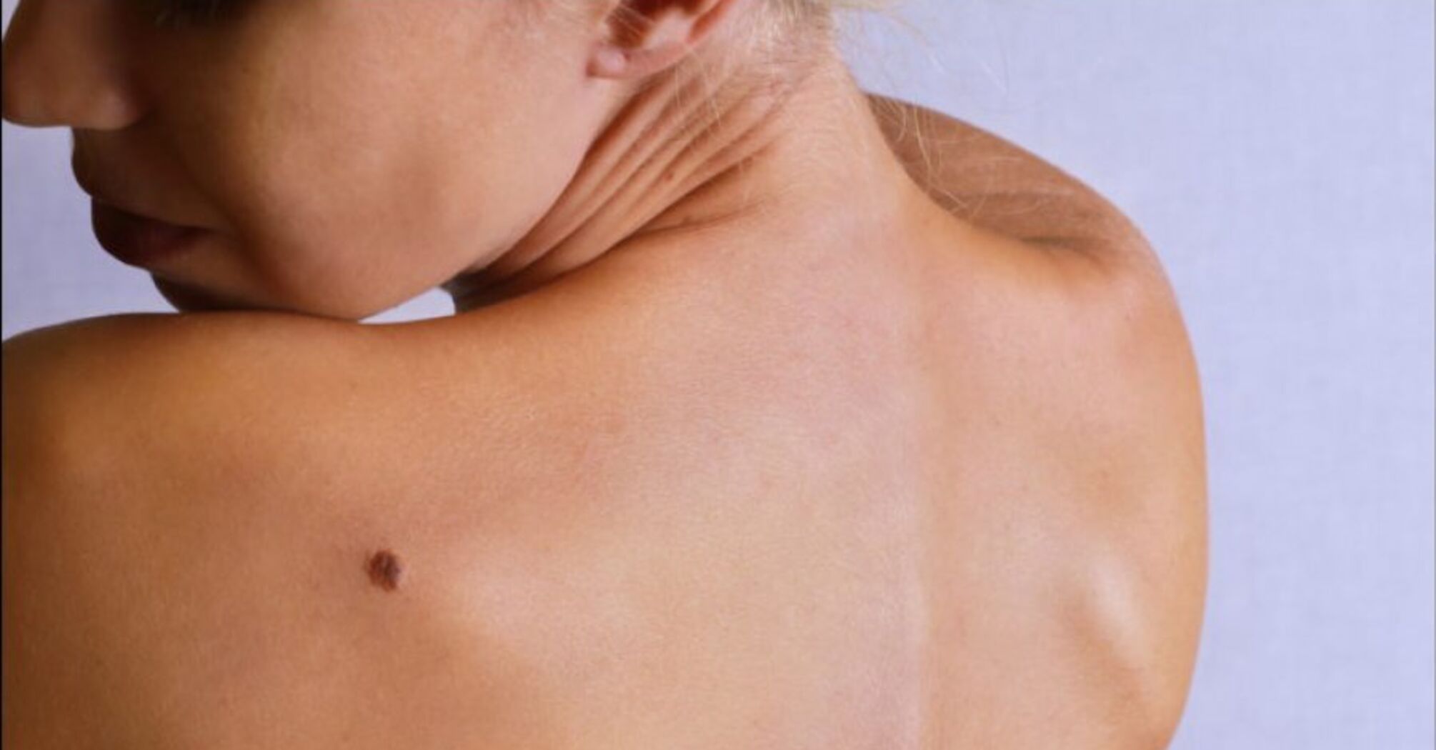 Міфи про родимки: знання може врятувати ваше життя