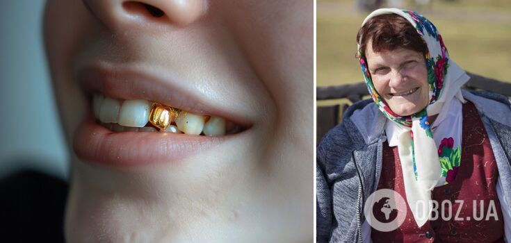 Why gold teeth were massively used in the USSR: where did the fashion come from